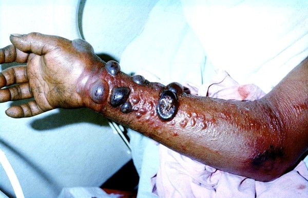  Cánh tay của một bệnh nhân nhiễm ebola 