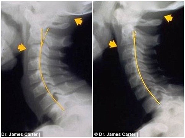 
Một bệnh nhân 6 tuổi bị biến dạng đốt sống cổ (trái) và hình ảnh sau khi được chữa trị (phải)

