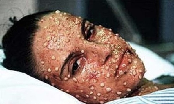  Bệnh nhân bị dịch hạch với hạch nhỏ nổi trên mặt 