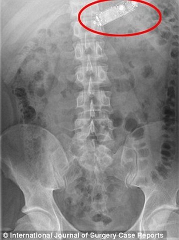  Ảnh X-quang chiếc điện thoại trong bụng bệnh nhân. 