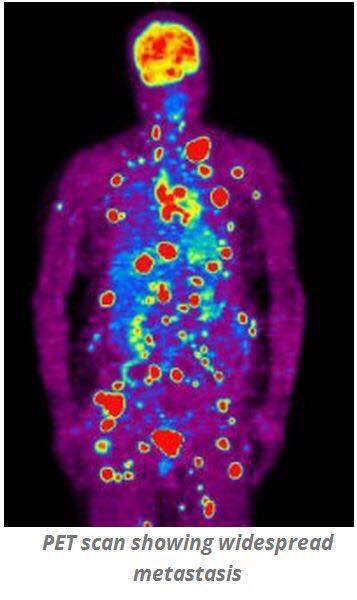  Hình ảnh chụp PET Scan của bệnh nhân ung thư giai đoạn di căn (Ảnh lấy từ diễn đàn chia sẻ phương pháp dinh dưỡng Keto phòng chống ung thư). 