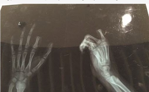 
Ảnh chụp X-quang bàn tay của Tiểu Bằng.
