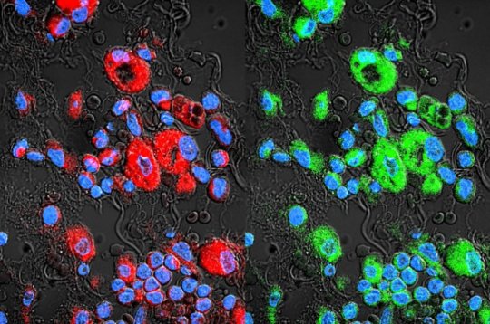  Các tế bào ung thư phổi kháng thuốc (màu đỏ) và exosome (màu xanh lá) chen chúc quanh đó 