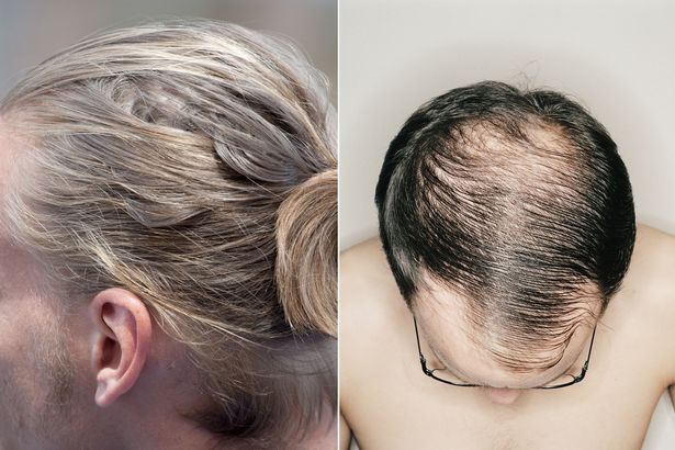  Buộc tóc quá chặt gây tổn thương các nang tóc dẫn đến chứng hói đầu! 