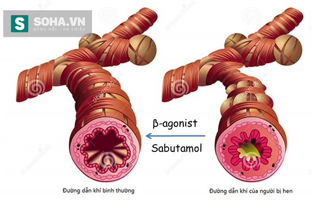 Salbutamol giúp làm giãn các cơ ở khí quản người bị hen.