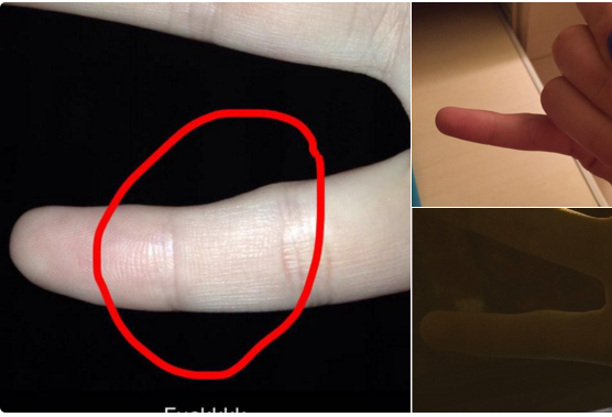 Nếu bạn nghĩ ngón tay mình sinh ra đã như thế thì có thể so sánh với ngón tay còn lại nhé.