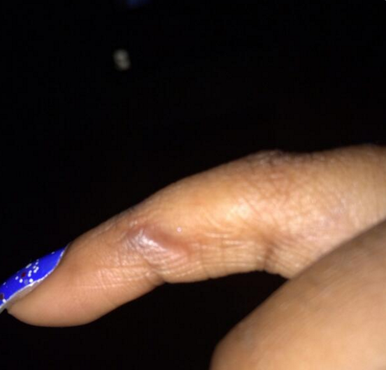 Một phụ nữ người Anh đăng tải bức ảnh ngón tay bị lõm hẳn xuống do smartphone