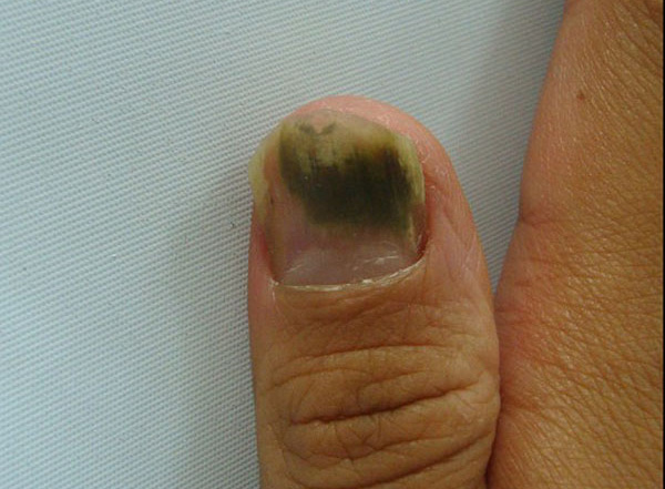  Nếu vi khuẩn phát triển dưới móng tay, nó sẽ trông như thế này 