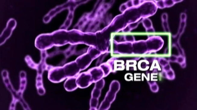  Gen BRCA đột biến được coi là một trong các nguyên nhân gây ung thư. 