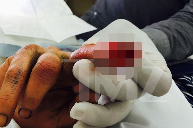 Võ sĩ MMA không biết ngón tay bị đứt lìa  VnExpress Thể thao
