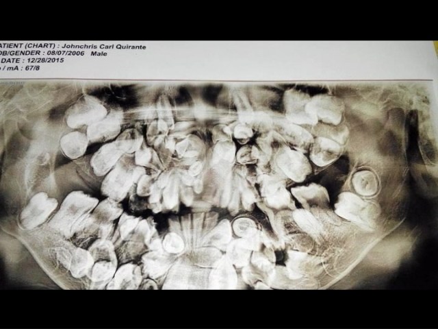 Ảnh chụp số lượng răng khủng khiếp của Quirante 