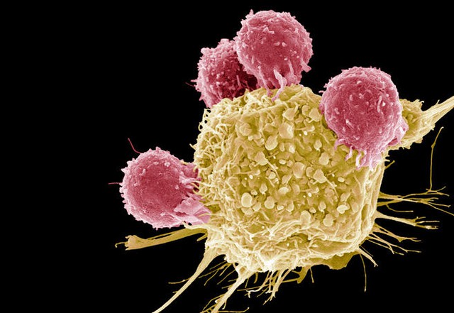  Ảnh chụp qua kính hiển vi mầu cho thấy các tế bào T (màu hồng) đang tấn công tế bào ung thư (màu vàng). 
