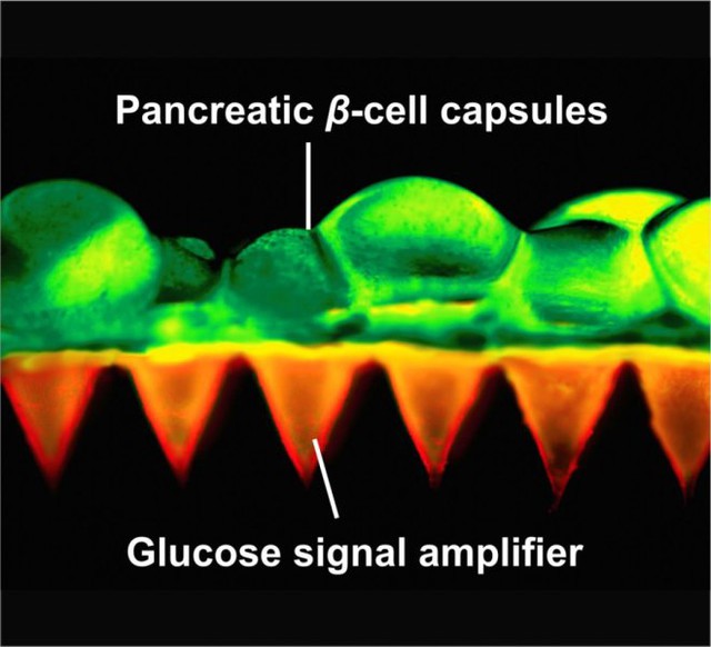  Thiết kế miếng dán với các tế bào β và cơ chế khuyếch đại tín hiệu đường glucose 