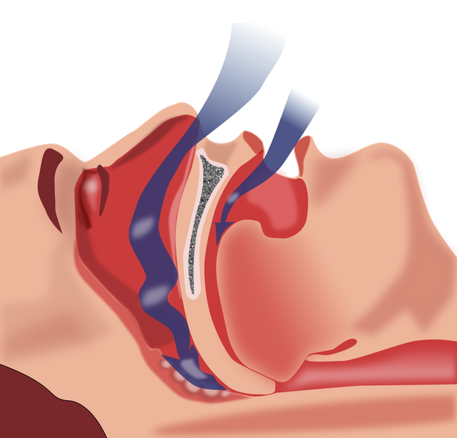  Ngưng thở khi ngủ gây ra bởi các mô mềm phía sau họng chặn đường thở 