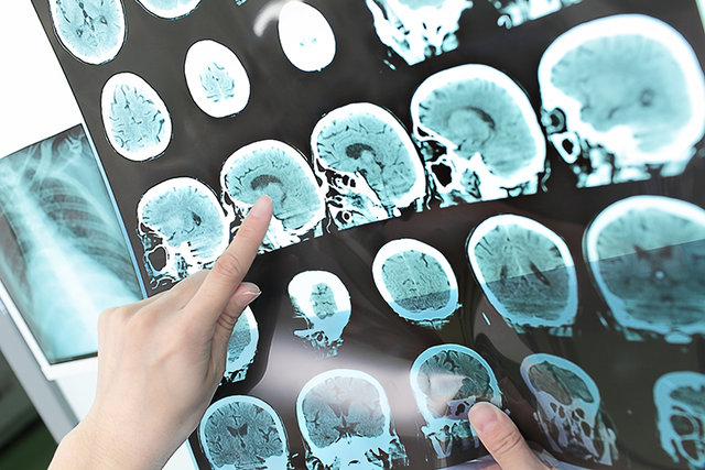  Cách tốt nhất để chẩn đoán chấn thương sọ não là chụp ảnh y tế 
