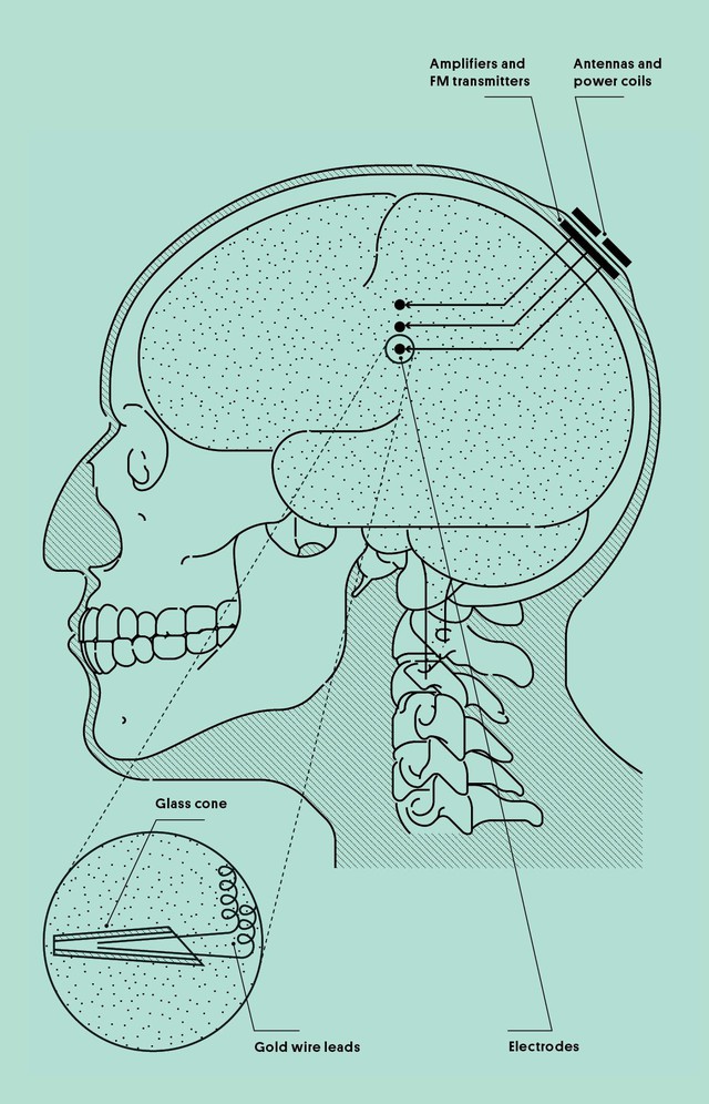  Minh họa việc đặt các điện cực của Kennedy vào trong não. 