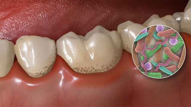  Hai loại vi khuẩn trong miệng có thể được sử dụng để tầm soát ung thư tuyến tụy 
