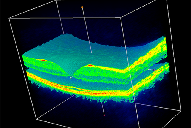  Hình ảnh 3D của võng mạc. 