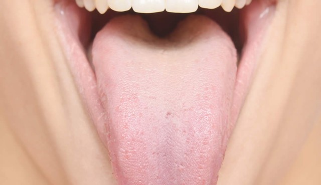  Lưỡi trắng là một dấu hiệu của bệnh gan 