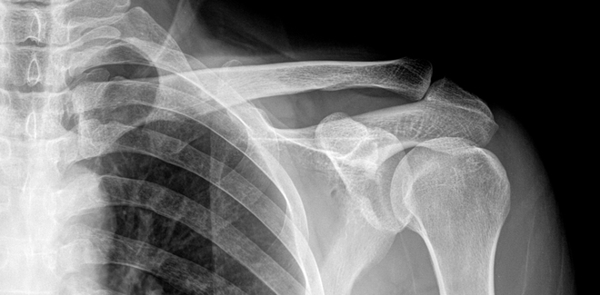  Chì nhiễm trong xương có thể được quan sát qua ảnh X-quang 