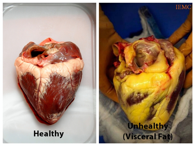  Hình bên trái là một trái tim khỏe mạnh. Hình bên phải là một trái tim bị mỡ bao bọc bên ngoài 