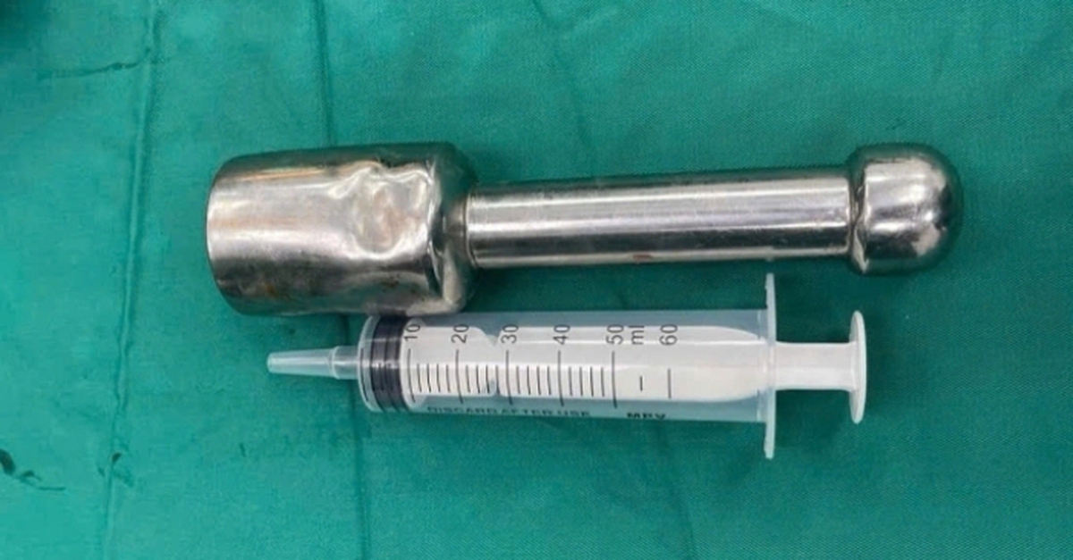 Chiếc chày 18 cm mắc kẹt trong trực tràng nam sinh 15 tuổi