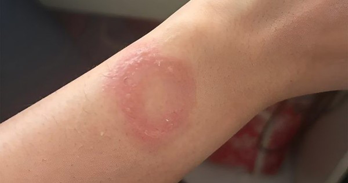 Người dùng Apple Watch phản ánh bị bỏng nặng và gặp khó khăn khi liên hệ hỗ trợ suốt 6 tháng