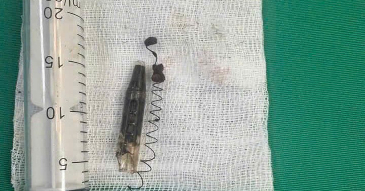 Chàng trai đau thái dương suốt 13 năm, bác sĩ phát hiện ra bí mật "đáng sợ" bên trong