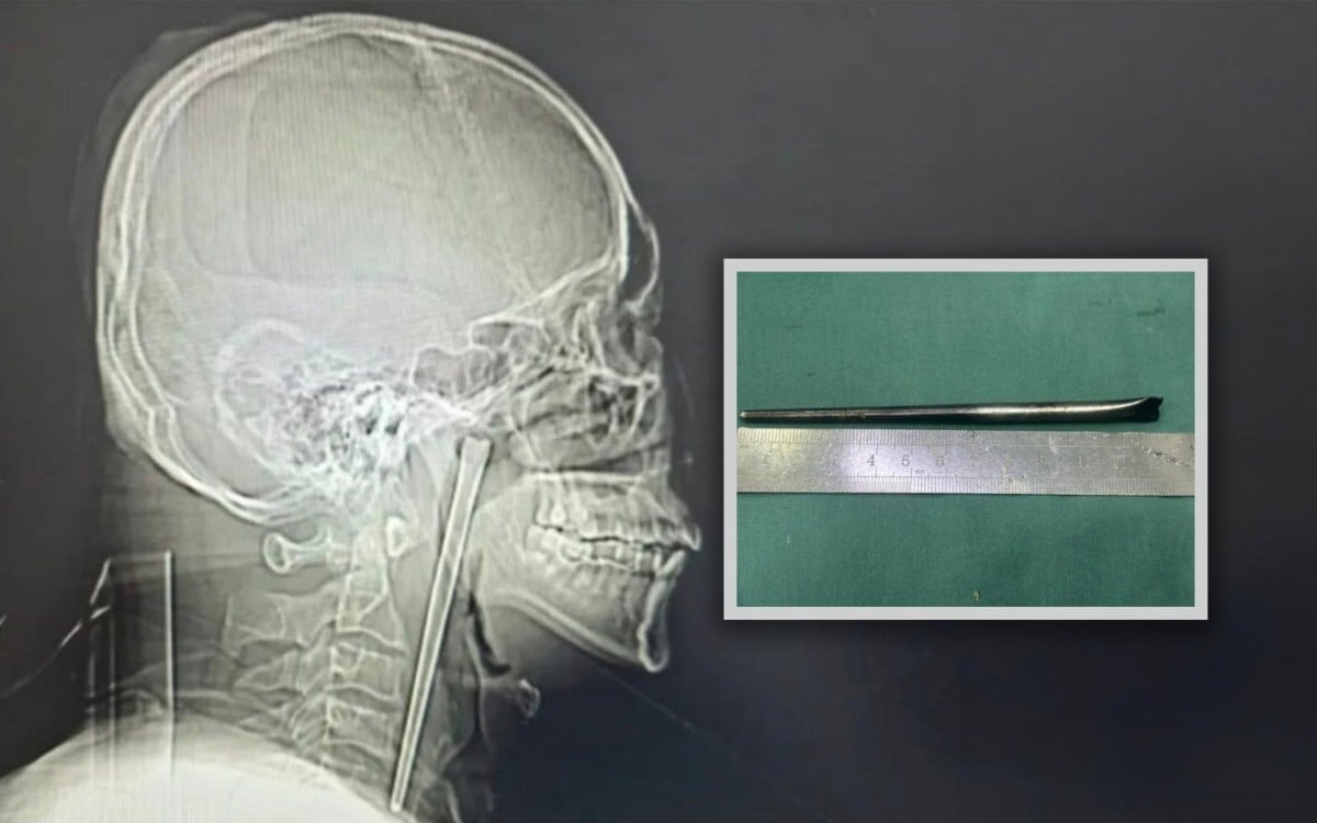 Người đàn ông sống 8 năm với chiếc đũa trong cổ họng và cái kết khiến cộng đồng mạng không thể tin nổi