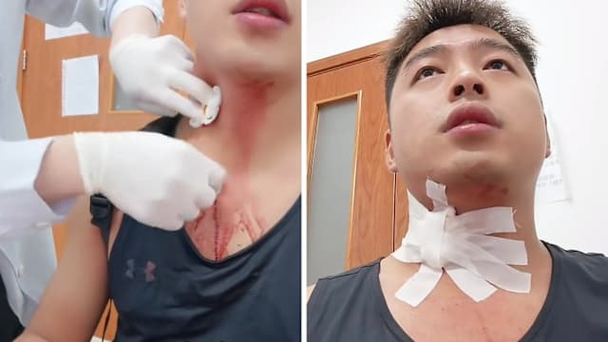 Người đàn ông suýt "gặp họa" vì một cú đập muỗi làm vỡ mạch máu ở cổ