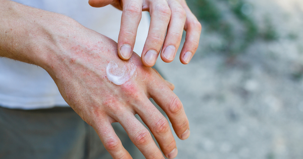 Protect yourself in the record sun to avoid pre-cancerous keratoses