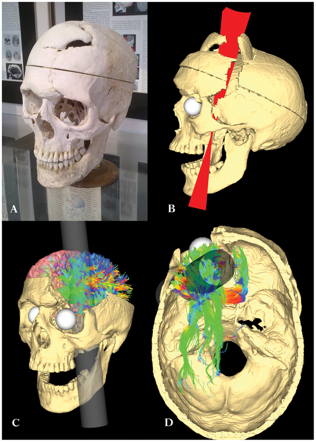 Phineas Gage and the accident gave birth to modern neuroscience - Photo 3.