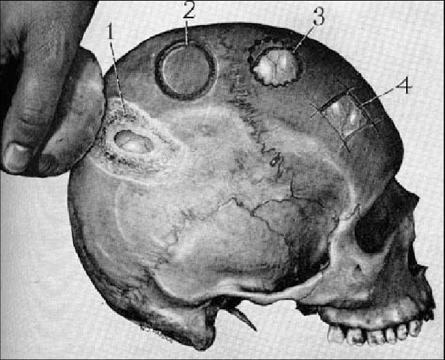 2000 năm trước ở Peru, người cổ đại đã có thể phẫu thuật hộp sọ mà không cần dùng đến thuốc gây mê hay thuốc kháng sinh - Ảnh 8.