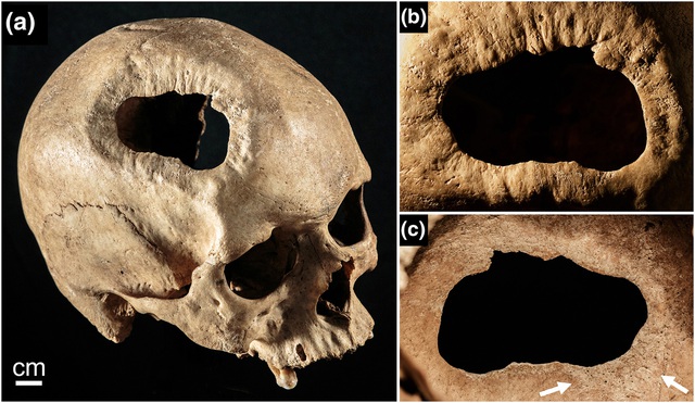 2000 năm trước ở Peru, người cổ đại đã có thể phẫu thuật hộp sọ mà không cần dùng đến thuốc gây mê hay thuốc kháng sinh - Ảnh 4.