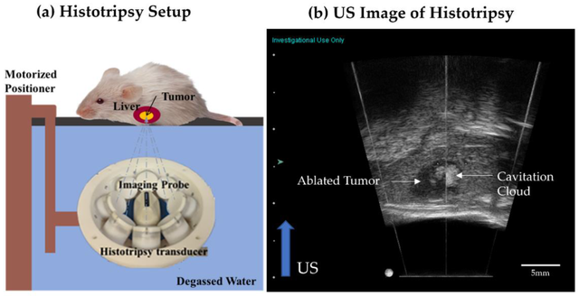 Breakthrough: An ultrasound technique helps to destroy liver cancer tumors without surgery - Photo 1.