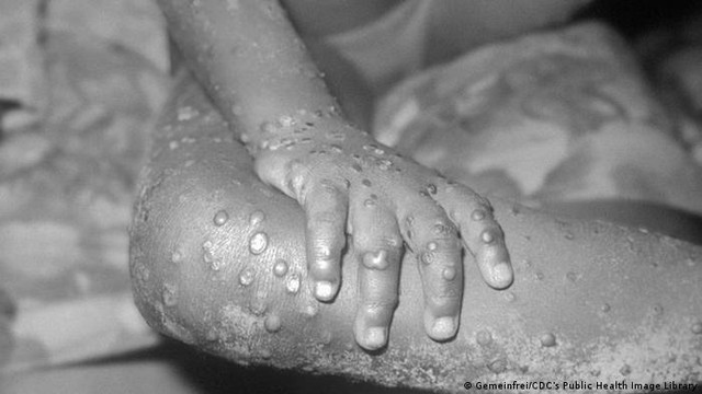 Monkeypox caused by MPXV virus broke out in Europe, here's what you need to know - Photo 3.