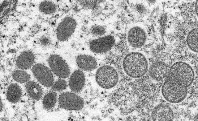 Bệnh đậu mùa khỉ do virus MPXV bùng phát ở Châu Âu, đây là những gì bạn cần biết - Ảnh 4.