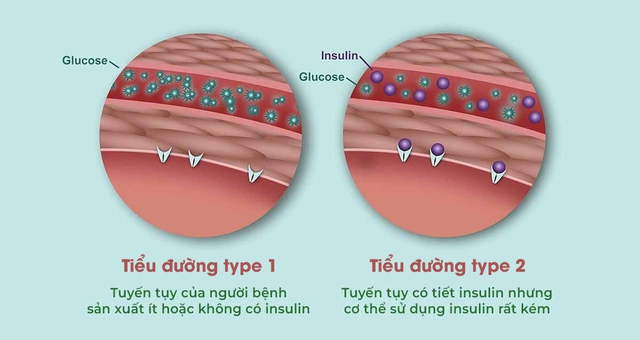 &quot;Mở khóa&quot; chức năng tiết insulin cho dạ dày: Một phương pháp hứa hẹn điều trị tận gốc bệnh tiểu đường - Ảnh 7.