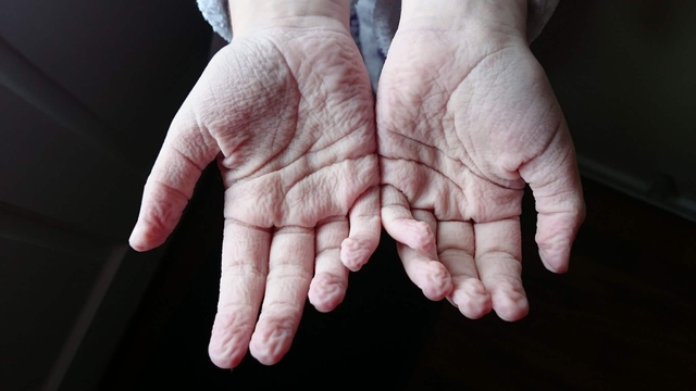 Why do your fingers wrinkle after a long bath or swim?  - Photo 1.