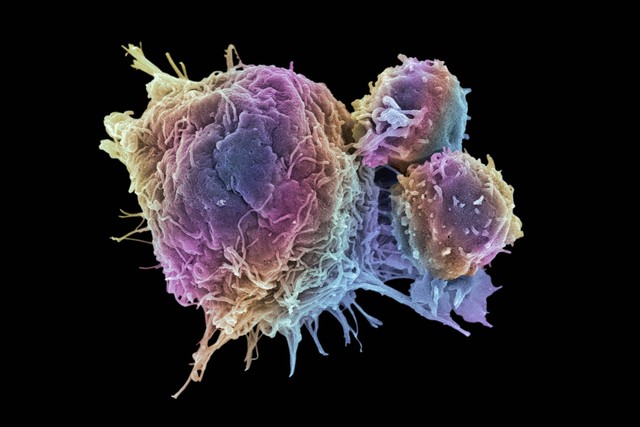 Tế bào ung thư tồn tại và phát triển trong cơ thể chúng ta như thế nào?- Ảnh 5.