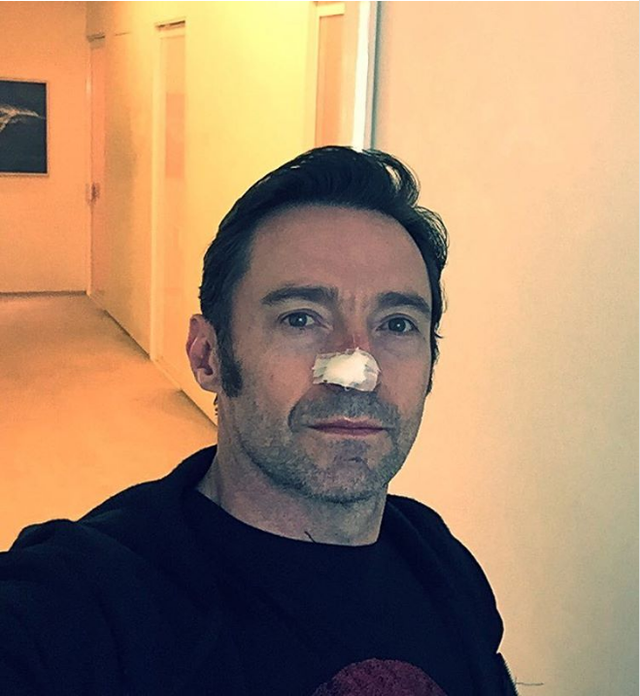 
Hugh Jackman mới được loại bỏ khối ung thư da ngay trên mũi
