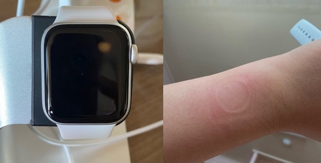 Apple Watch SE gặp lỗi quá nhiệt, khiến người dùng bị bỏng và làm hỏng màn hình - Ảnh 1.