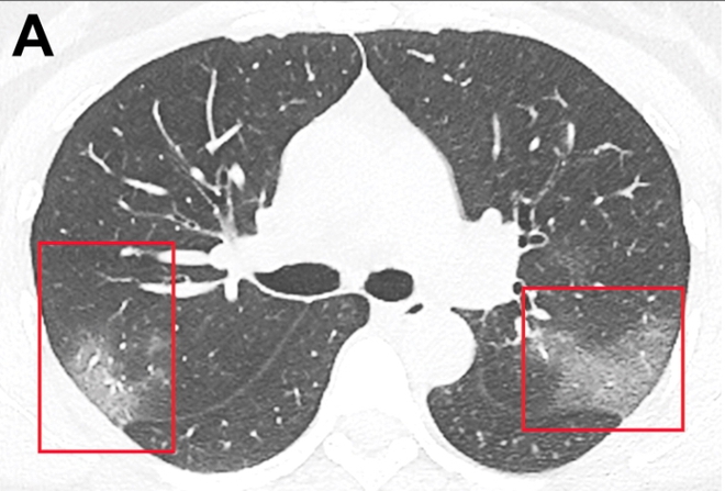 Ảnh chụp cắt lớp CT một lá phổi của bệnh nhân Covid-19 thể hiện các tổn thương ở hai thùy.