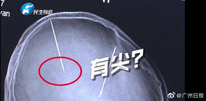 Sau tai nạn ô tô người phụ nữ Trung Quốc bất ngờ phát hiện có hai cây kim được găm vào trong não mà không hề có ký ức gì - Ảnh 3.