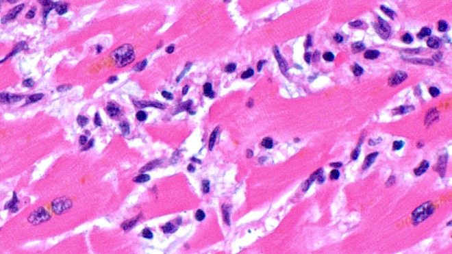 Khoảng 3/4 bệnh nhân COVID-19 có những con virus trong tim mình - Ảnh 2. Khoảng 3/4 bệnh nhân COVID-19 có những con virus trong tim mình - Ảnh 2.
