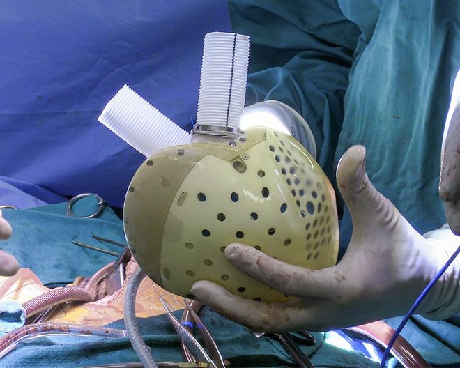 Trái tim nhân tạo đầu tiên vừa được ghép cho bệnh nhân tại Mỹ, có cả bộ điều khiển và pin sạc - Ảnh 3.