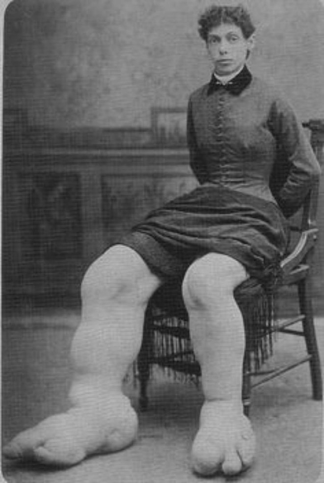 Fanny Mills - Cô gái chân to Ohio, người được mệnh danh là có đôi bàn chân to nhất Trái Đất! - Ảnh 2.