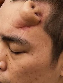 Không phải ảnh lỗi của AI, người đàn ông này đã thực sự mọc một chiếc mũi trên trán: Đó là "tác phẩm" của các bác sĩ Trung Quốc