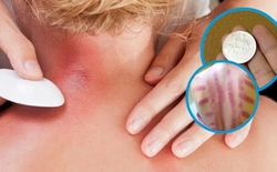 Vì sao đau mỏi người, 'trúng gió' dùng đồ bạc, trứng gà để cạo gió?