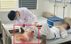 Đắp lá chữa bỏng suốt 1 tháng theo kinh nghiệm dân gian, người đàn ông suýt mất chân vì hoại tử lan đến xương